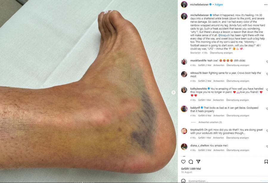 Michelle Beisner zeigt ihren kaputten Fuss auf Instagram.