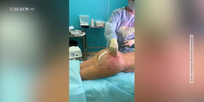 Dieser Eingriff ging richtig in die Hose: Anstatt vergrösserter Brüste wachte die Russin nach der OP mit einem XL-Hinterteil auf. Russin OP Brust Po