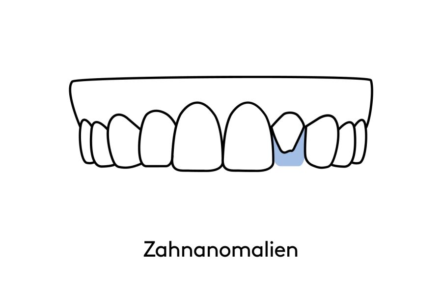 Das kann bestsmile mit Veneers korrigieren.