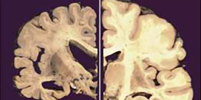 Im Gehirn eines Menschen mit Alzheimer (links): Die Grosshirnrinde schrumpft – mit drastischen Folgen für die Betroffenen. (Archivbild) Demenz Welt-Altheimertag