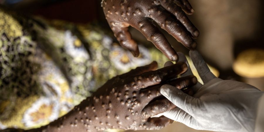 Der Mpox-Ausbruch in der Demokratischen Republik Kongo führte im August 2024 zur Ausrufung eines internationalen Gesundheitsnotstands durch die WHO. (Archivbild)