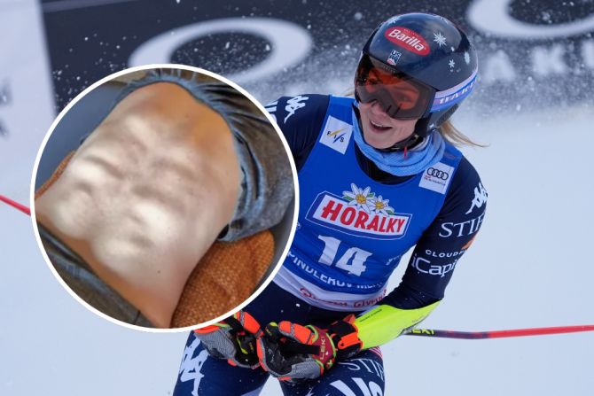 Mikaela Shiffrin Rücken