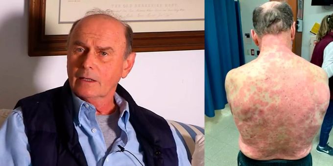 Der 74-jährige Richard Terrell hatte mit einer sehr seltenen Reaktion auf seine Coronavirus Impfung zu kämpfen. Coronavirus