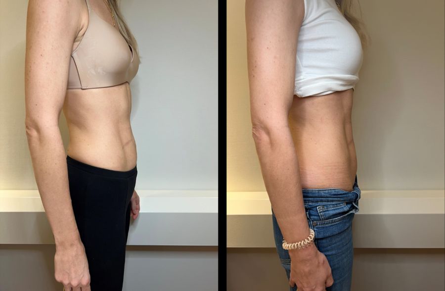 Der Bauch wirkt straffer und flacher.