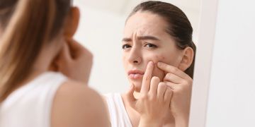 Junge Frau mit Pickeln