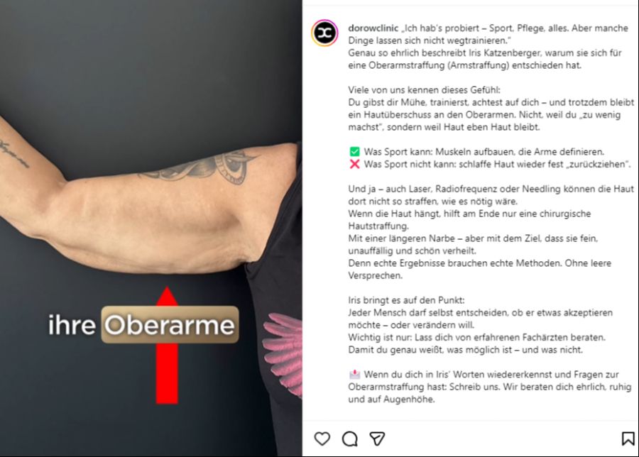 Die 58-Jährige lässt sich die überschüssige Haut entfernen.