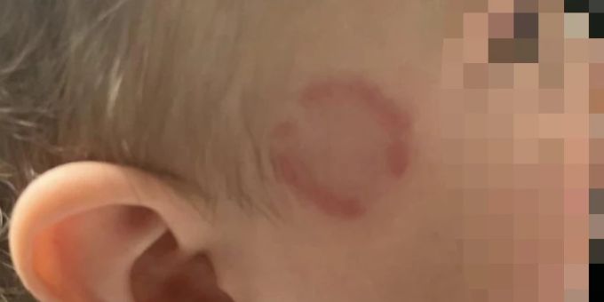 Dieses Kind wurde in der Kita gebissen – kein Einzelfall. Kita