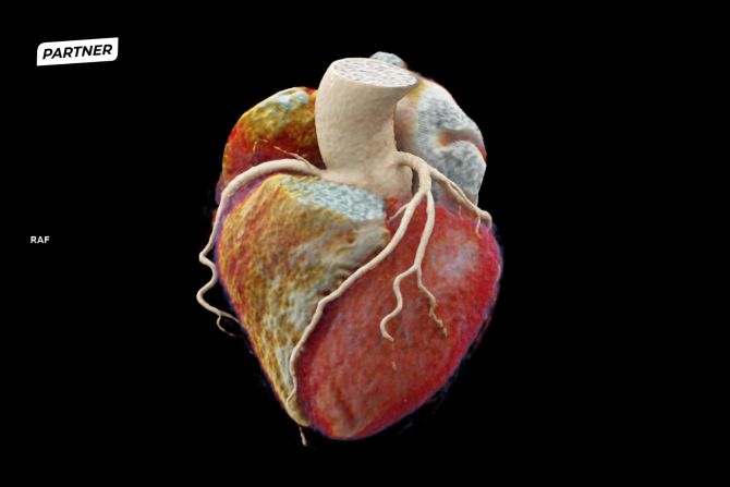 Computertomographie-Aufnahme eines menschlichen Herzens.