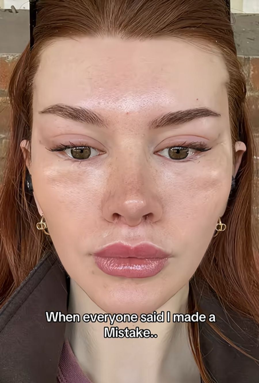 Facelift