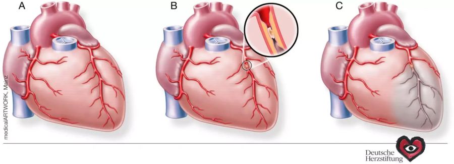 Grafik Herzinfarkt