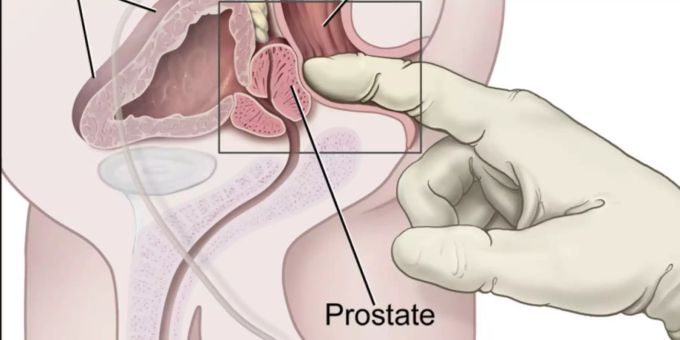Prostatakrebs - Forschung gibt Anlass zur Hoffnung