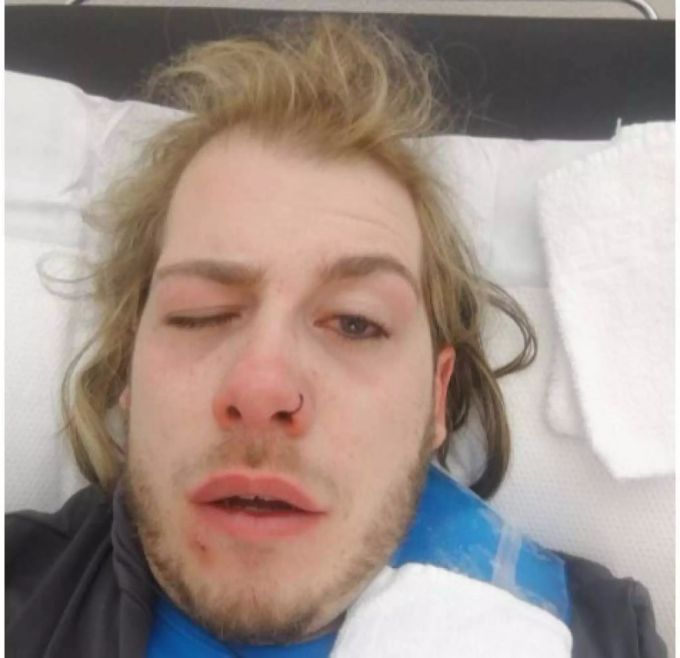 Das Opfer erlitt einen Haarriss an der Nasenscheidewand sowie Prellungen im Gesicht. Das Opfer erlitt einen Haarriss an der Nasenscheidewand sowie Prellungen im Gesicht.