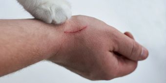 Ein Katzenkratzer schmerzt und brennt oft intensiv.