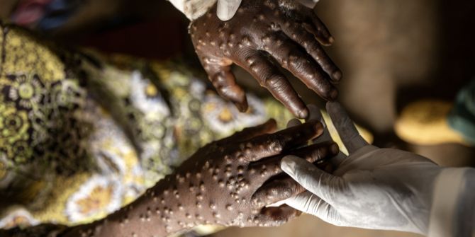 mpox Ausschlag Hände