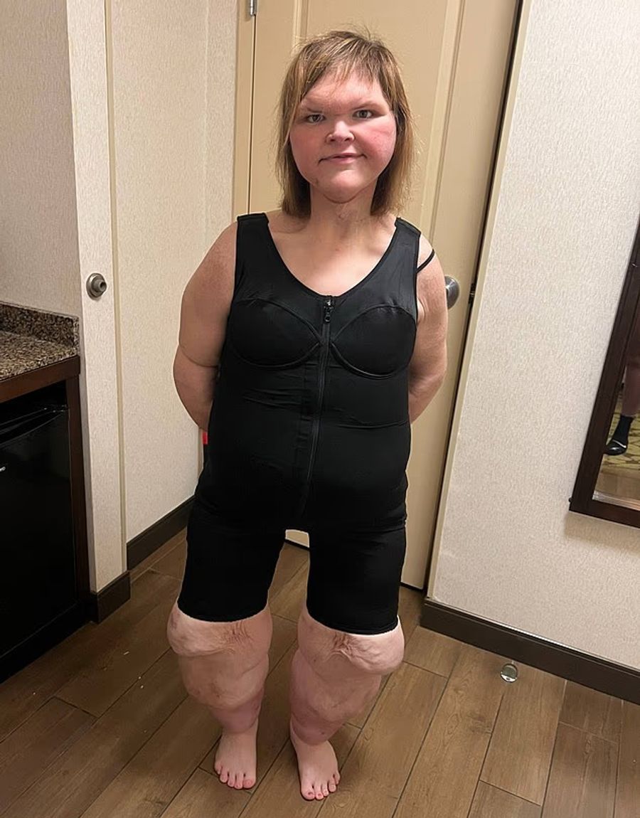 Nun aber hat sie über 200 Kilo abgenommen und ist kaum wiederzuerkennen.