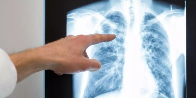 Genf - Corona wirft Kampf gegen Tuberkulose um Jahre zurück