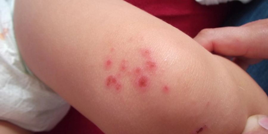 Hautausschlag Baby Dermatitis