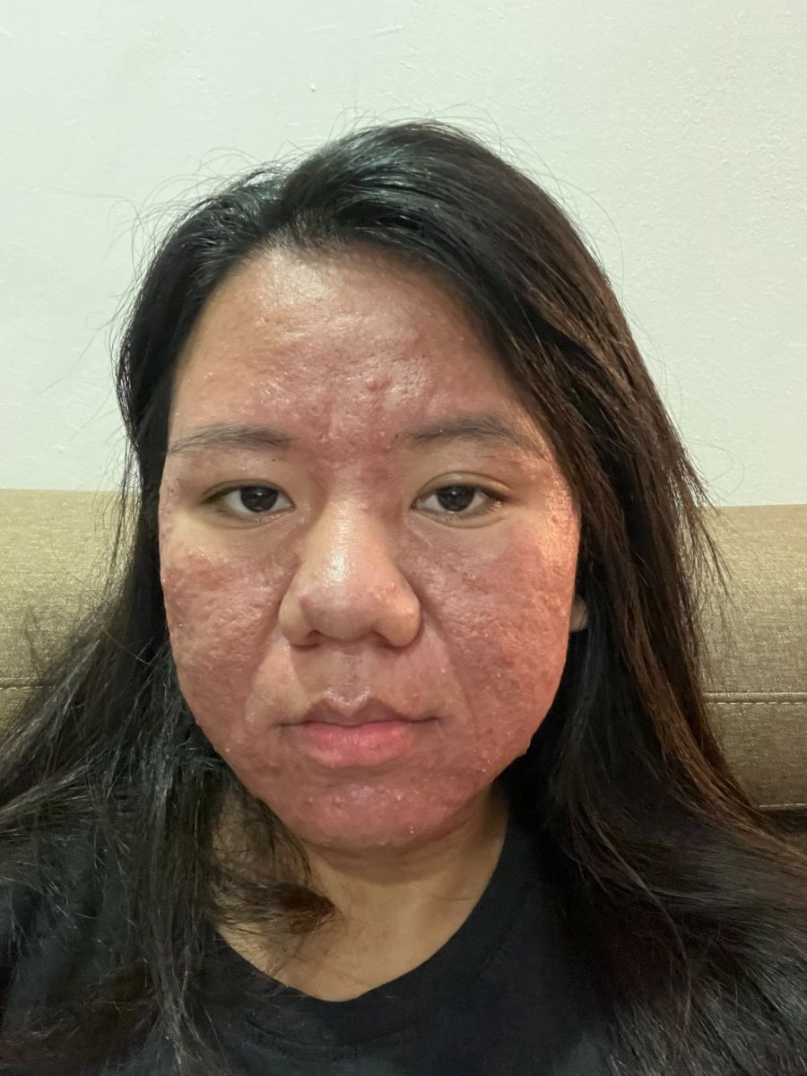 Nach der Schwangerschaft begann die junge Frau eine Gesichtsbehandlung.