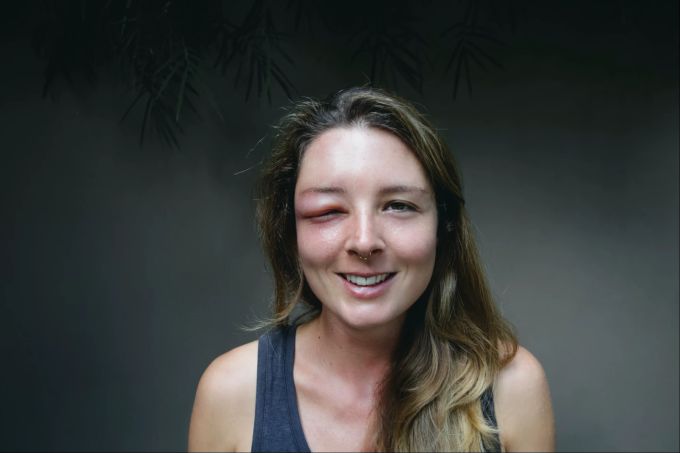 Frau mit geschwollenem Auge: So kann eine allergische Reaktion auf einen Wespenstich aussehen. Frau mit geschwollenem Auge