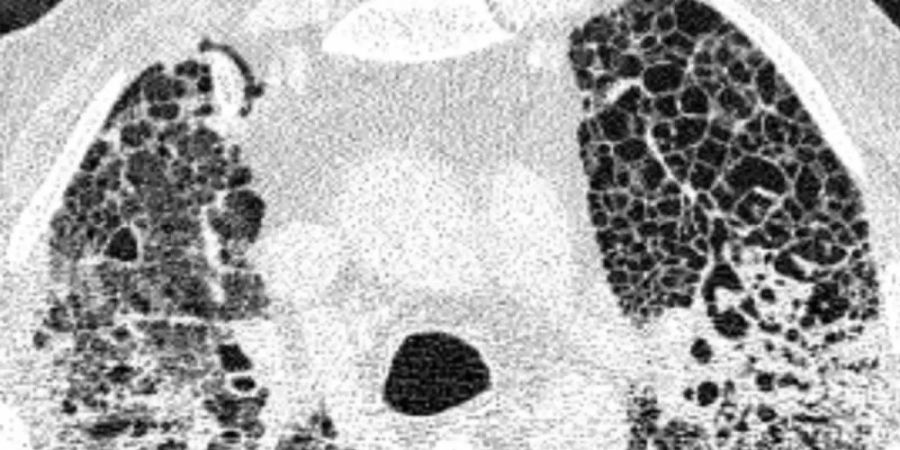 Computertomographie-Aufnahme (CT-Bild) der Lunge eines Patienten mit COVID-19-Lungenversagen. Helle Bereiche zeigen Verdichtungen und Vernarbungen des Lungengewebes. Foto: -/Charité/dpa