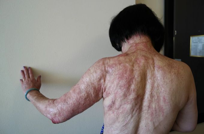 PhanThi Kim Phúc erlitt damals schwere Verbrennungen, die ihre Spuren hinterlassen haben. phan th? kim phúc