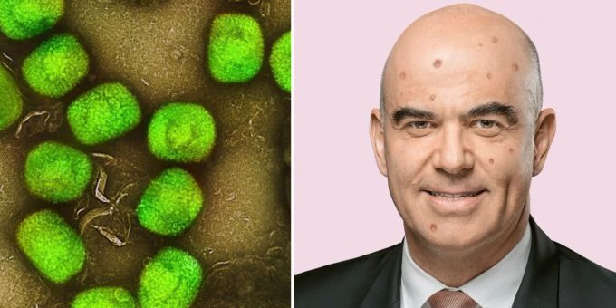 Dieses Bild von Alain Berset stellt Checkpoint Zürich auf Instagram. Die Organisation hat einen Aufruf an den Bundesrat gestartet. Die queere Gesundheitsorganisation fordert die Beschaffung von Pocken-Impfungen wegen der Ausbreitung der Affenpocken. alain berset