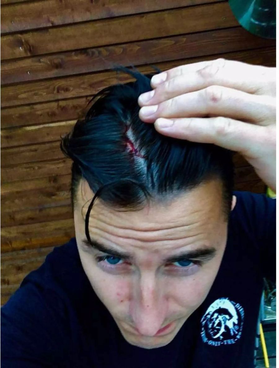 Wegen dieser Kopfwunde hat Andreas Gabalier Sexverbot.
