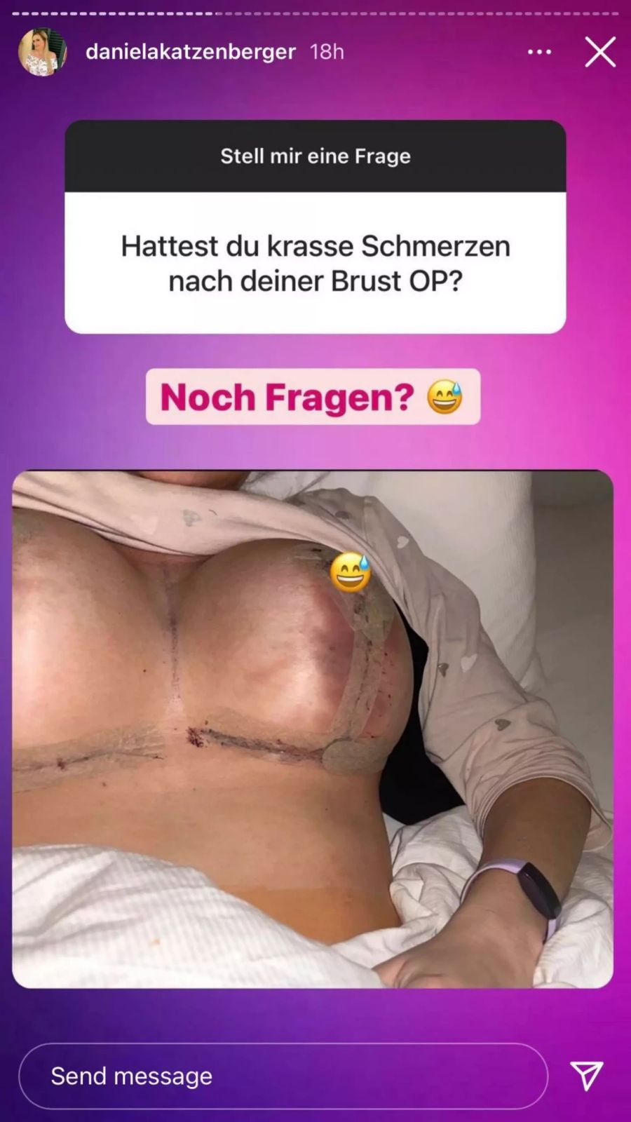 Autsch! So sahen die Narben kurz nach der OP aus.