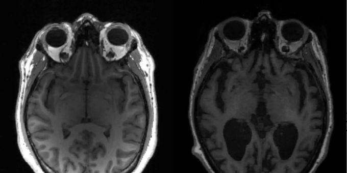 Die Aufnahme zeigt ein gesundes Hirn und eines mit der Alzheimer-Krankheit. Alzheimer-Krankheit