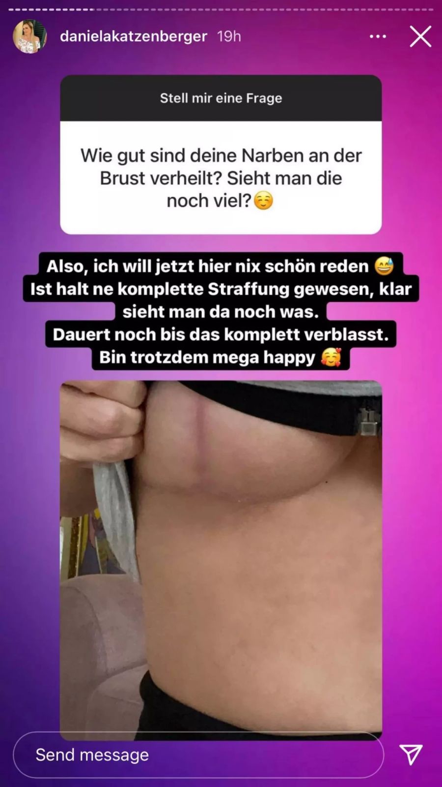 Daniela Katzenberger zeigt ihre OP-Narben.