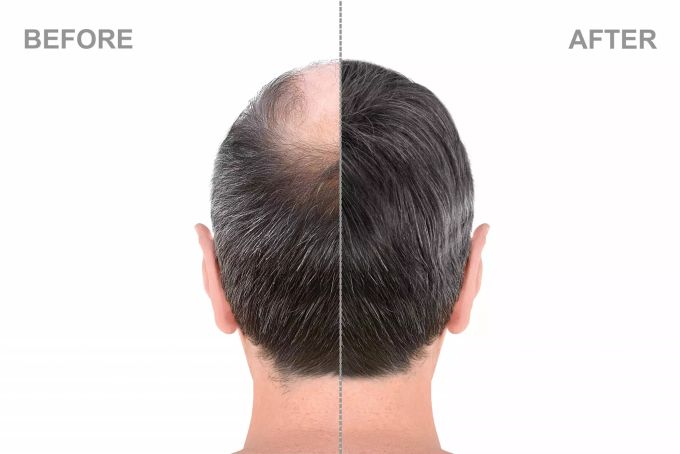 X Hair Forte im Test. d