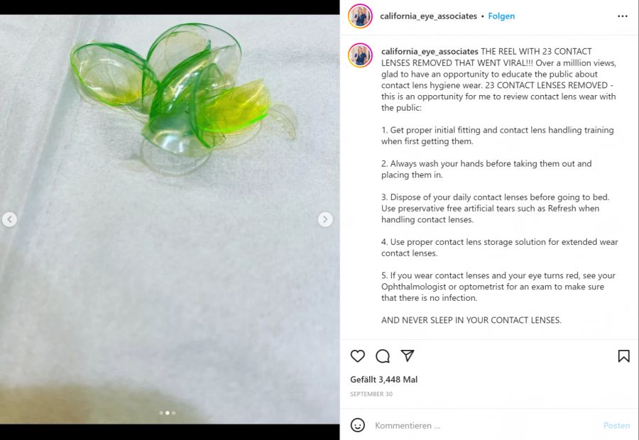 Die Frau hatte sich 23 Tage hintereinander Kontaktlinsen eingesetzt, ohne die alten zu entfernen.