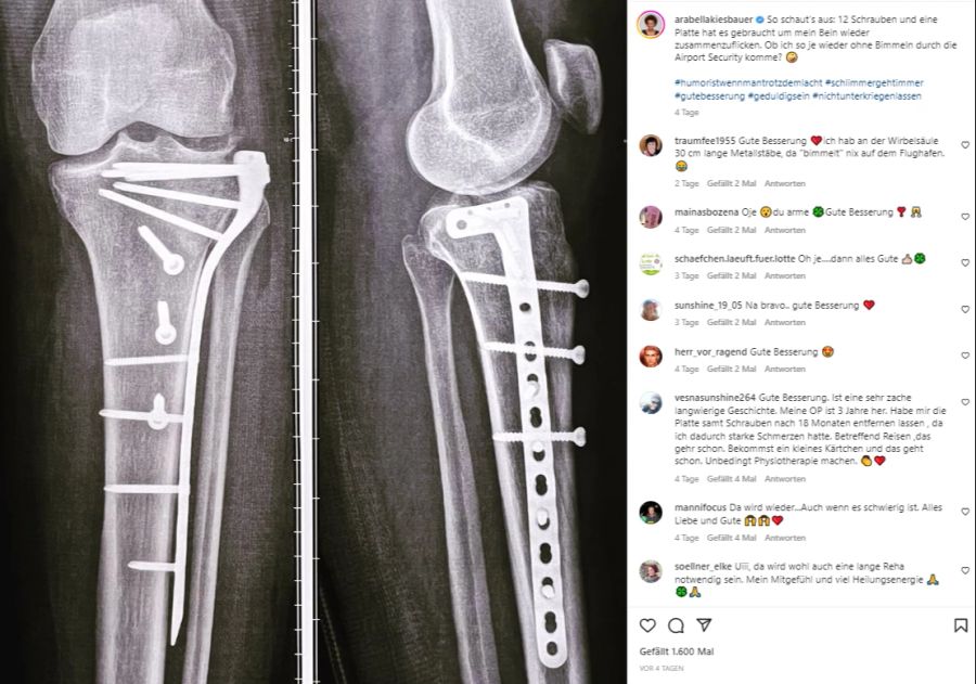 Nichts für schwache Nerven! Arabella Kiesbauers Bein musste mit zwölf Schrauben zusammengeflickt werden.