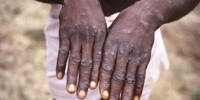 Eine neue Variante des Mpox-Virus könnte für eine weltweite Verbreitung der «Affenpocken» sorgen. (Archivbild) affenpocken
