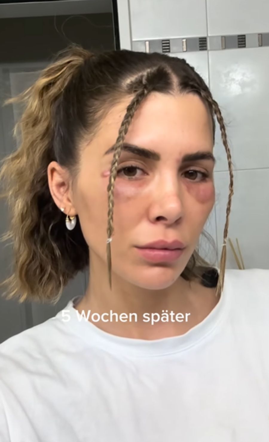 Ein Beauty-Eingriff sollte gut überlegt sein, warnt sie ihre Follower nun.