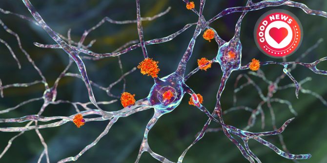 Gehirn Verklumpungen Proteine Alzheimer