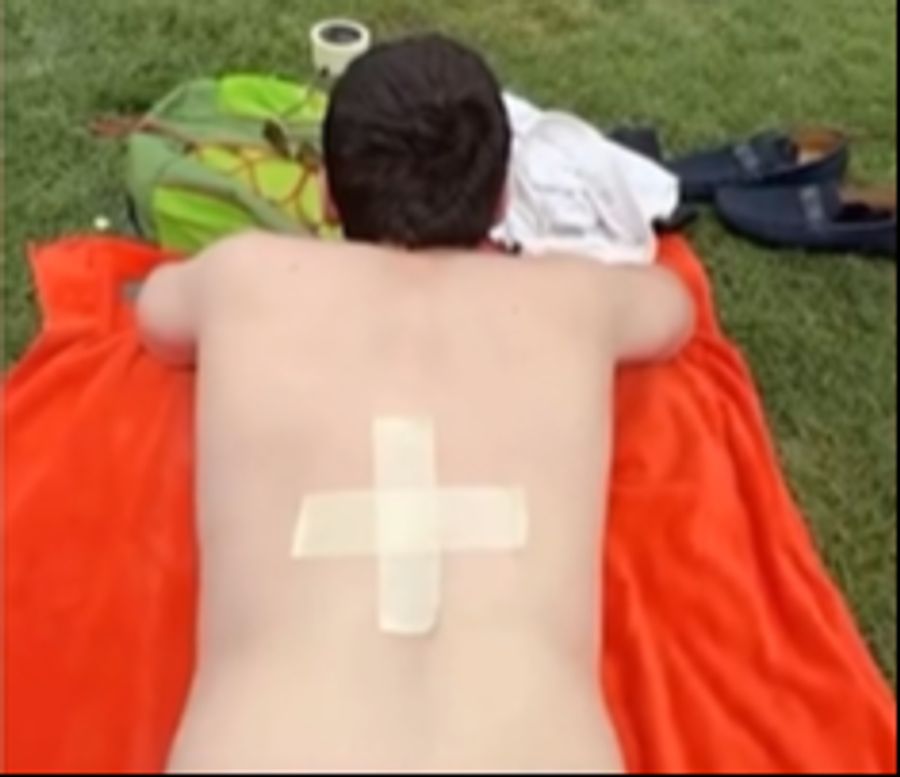 Sonnenbrand