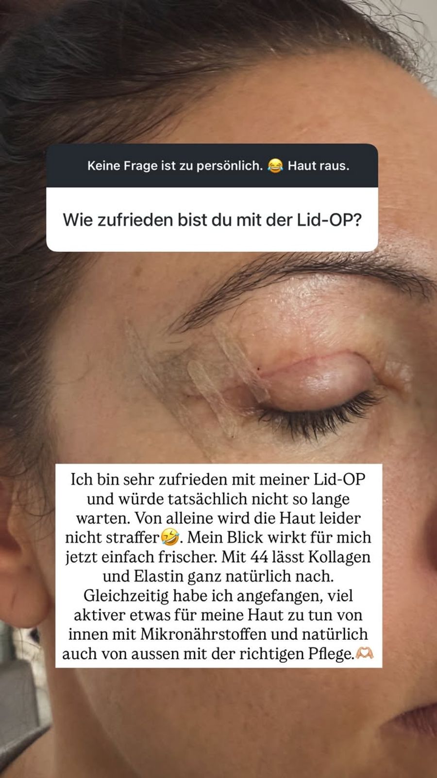 Auch ihre Lidstraffung bereut Frieda Hodel nicht. Rückblickend würde die 44-Jährige mit dem Eingriff sogar weniger lange warten.