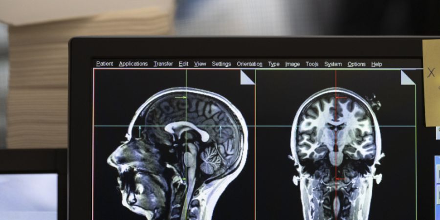 Mit einem Magnetresonanztomographen (MRT) lassen sich in Gehirnen von Schmerzpatienten Veränderungen nachweisen. (Symbolbild)