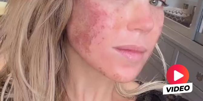 Nach CO2-Laser-Behandlung