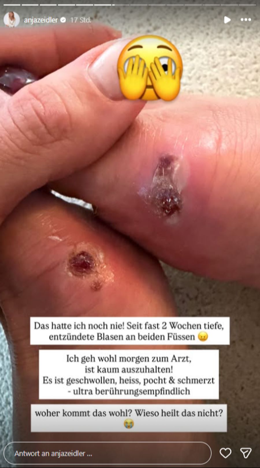 Anja Zeidler zeigt die entzündeten Blasen an ihren Füssen. Autsch!