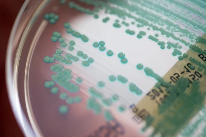 Bei lokalen Hautinfektionen mit dem MRSA-Keim treten Rötung, Schwellung, Überwärmung, Schmerzen und mögliche Eiteransammlungen auf horst janson mrsa