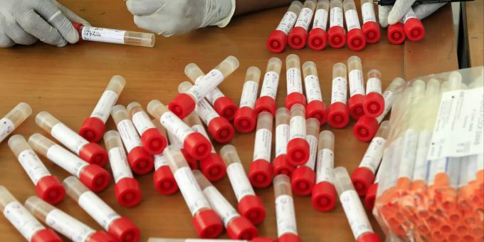 In Graubünden muss sich das ungeimpfte Gesundheitspersonal auf Covid testen lassen. Test Covid