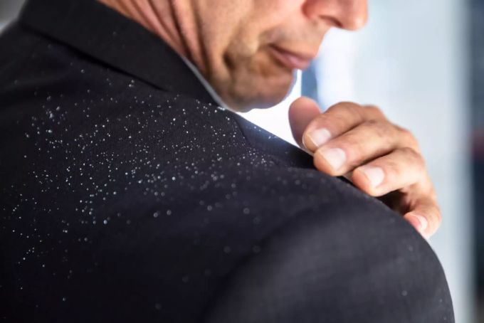 Schuppen können auch auftreten, wenn die Haare nicht richtig gepflegt werden. Schuppen