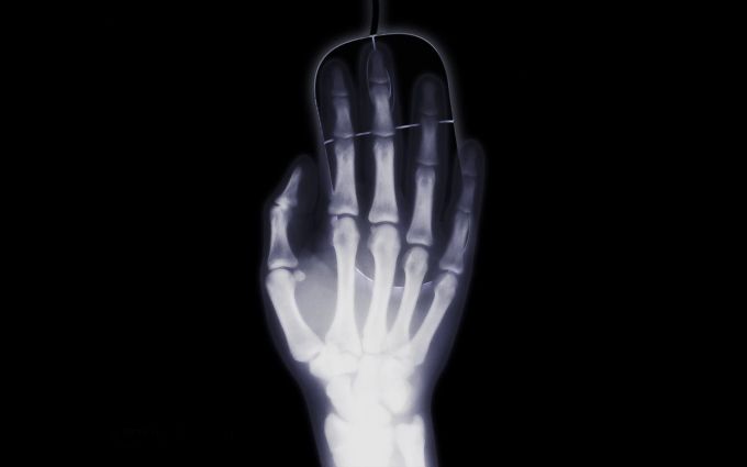 Monotone Bewegungsabläufe wie zum Beispiel mit der Maus können zu Sehnenscheidenentzündungen führen. Hand Röntgenbild Maus Mouse