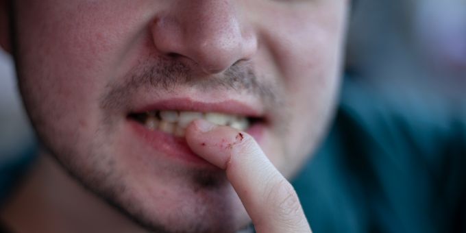 Ein Jugendlicher beisst in Luzern einem Polizisten in die Hand und flüchtet. (Symbolbild) beissen Mann Zähne