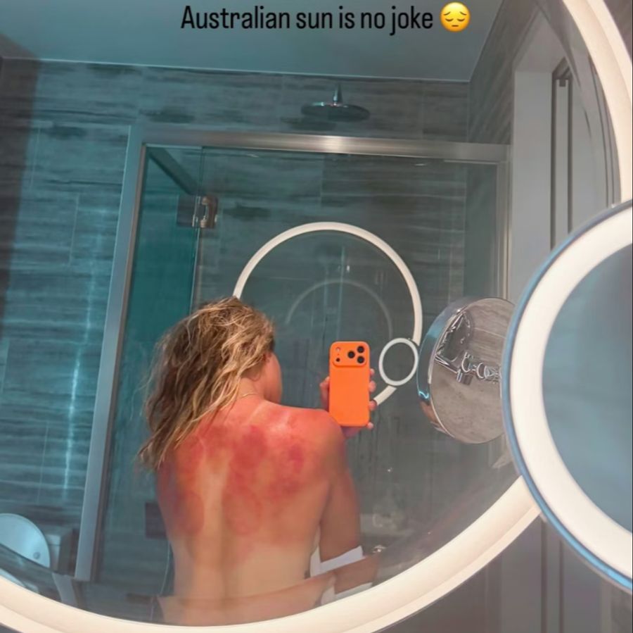 Nun hat sich die 28-Jährige im Vorfeld der Australian Open heftig verbrennt.
