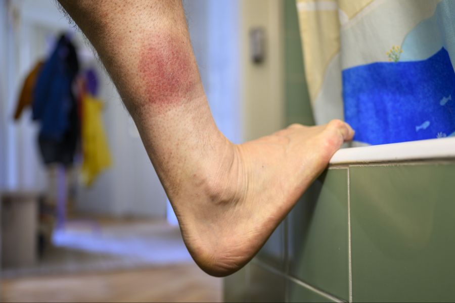Zecken können Krankheiten wie Borreliose übertragen.