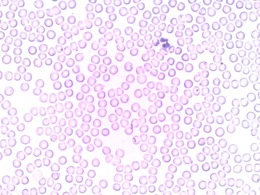 Immunthrombose Covid 19