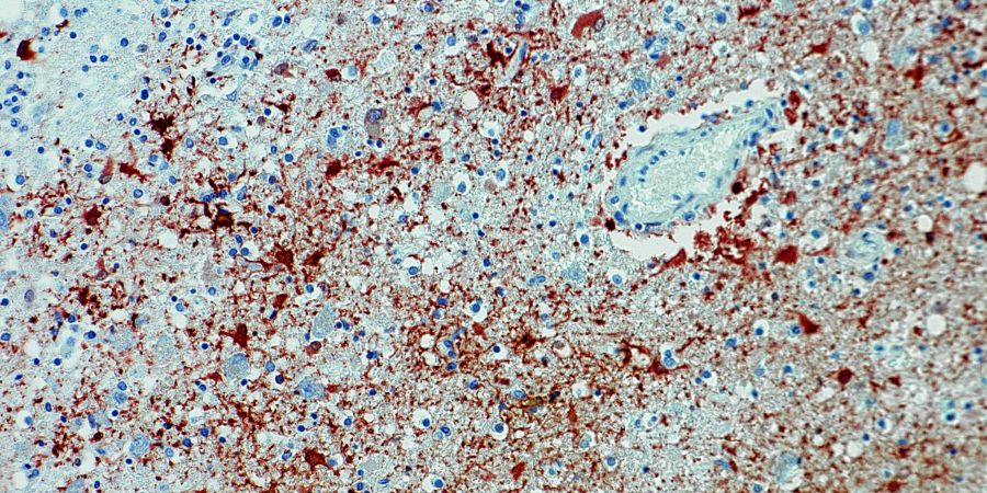 Die undatierte Aufnahme zeigt einen Anitkörpernachweis zum Borna-Virus im Gewebe.